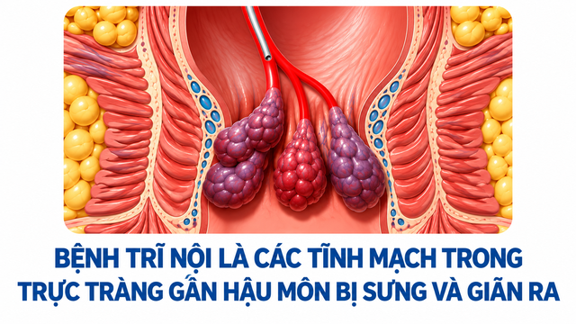 Tại sao cùng sa búi trĩ, người sinh hoạt bình thường, người lại phải phẫu thuật? - Ảnh 1.