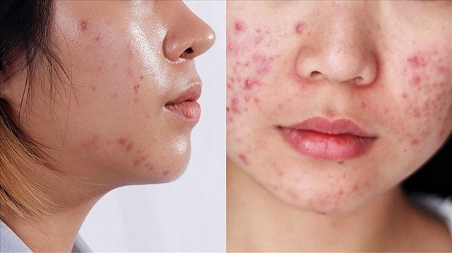Skincare da dầu mụn mãi không đẹp khi giao mùa? Thậm chí da còn nhạy cảm hơn? - Ảnh 2.