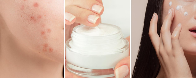 Da dầu mụn cứ skincare là bít tắc: Bạn có đang bỏ quên bước quan trọng này?- Ảnh 2.