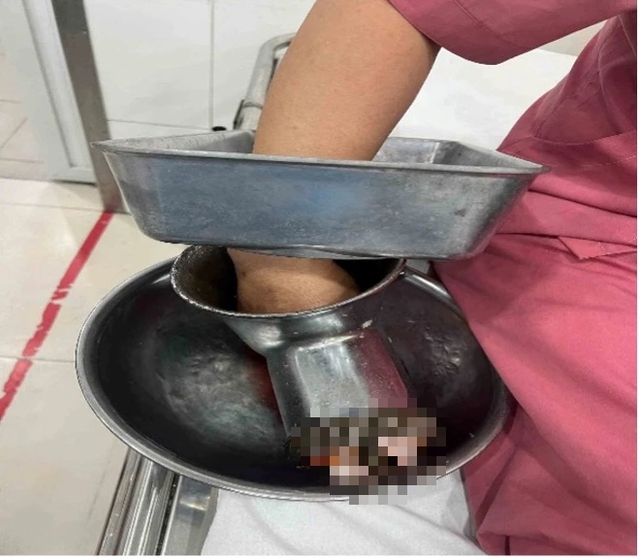 Bị máy xay thịt 'nuốt' bàn tay, người phụ nữ ở TP.HCM phải cắt cụt 3 ngón- Ảnh 1.