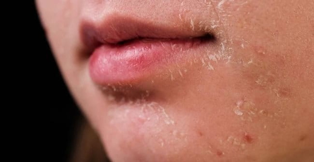 Da dầu mụn bóng dầu lại khô căng: Lý do khiến nhiều người ngỡ ngàng không tin- Ảnh 1.
