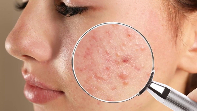 Da dầu mụn bóng dầu lại khô căng: Lý do khiến nhiều người ngỡ ngàng không tin- Ảnh 2.