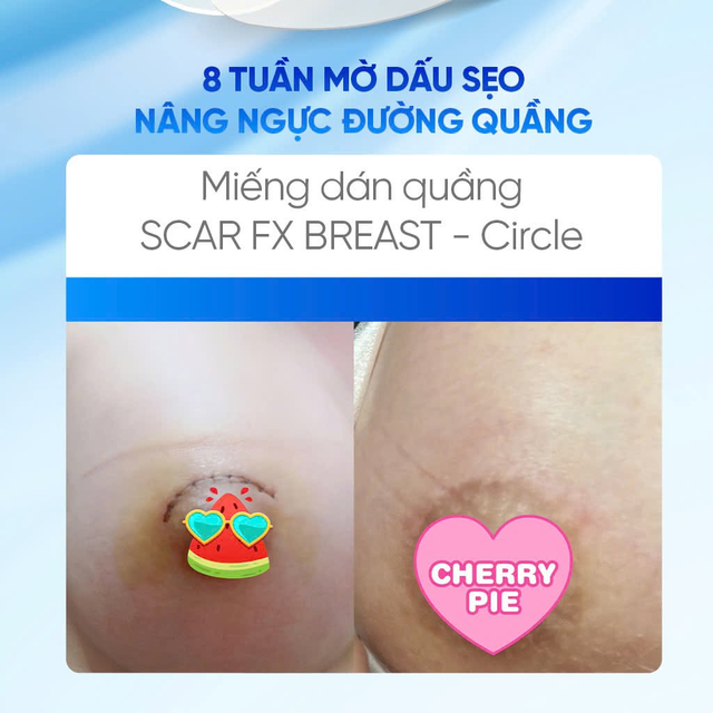 Nâng ngực nội soi: Các đường mổ, rủi ro và cách quản lý sẹo sau phẫu thuật- Ảnh 6.