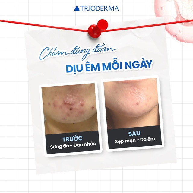 Mụn viêm sưng đỏ: Chấm gì vừa giúp xẹp mụn sau khoảng 1 đêm vừa ngừa sẹo? - Ảnh 1.