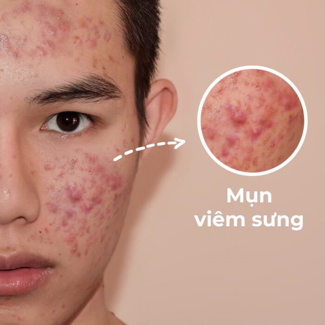 Mụn viêm sưng đỏ: Chấm gì vừa giúp xẹp mụn sau khoảng 1 đêm vừa ngừa sẹo? - Ảnh 2.