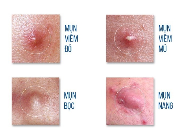 Mụn viêm sưng đỏ: Chấm gì vừa giúp xẹp mụn sau khoảng 1 đêm vừa ngừa sẹo? - Ảnh 3.