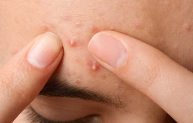 Mụn viêm sưng đỏ: Chấm gì vừa giúp xẹp mụn sau khoảng 1 đêm vừa ngừa sẹo? - Ảnh 5.