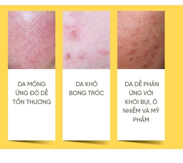 Giải m&atilde; những điều da cần khi trời đổi m&ugrave;a d&agrave;nh cho l&agrave;n da nhạy cảm - Ảnh 3.