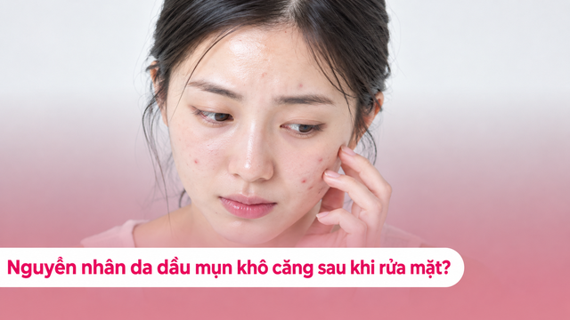 Càng rửa mặt da dầu mụn càng khô căng khó chịu? Hay dùng sai sữa rửa mặt?- Ảnh 1.