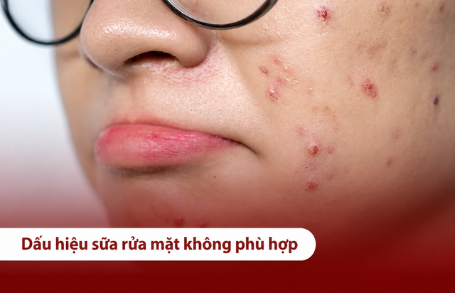 Càng rửa mặt da dầu mụn càng khô căng khó chịu? Hay dùng sai sữa rửa mặt?- Ảnh 2.