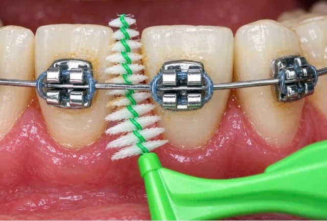 Niềng răng có khiến răng yếu, lung lay và dễ rụng sớm? - Ảnh 2.