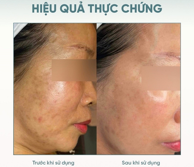 +4 serum tranexamic acid giúp mờ nám chân đinh lâu năm sau khoảng 8 tuần kiên trì - Ảnh 1.