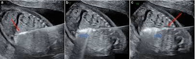 Đột phá y học với ca thu nhỏ khối u cho thai nhi ngay trong bụng mẹ - Ảnh 1.