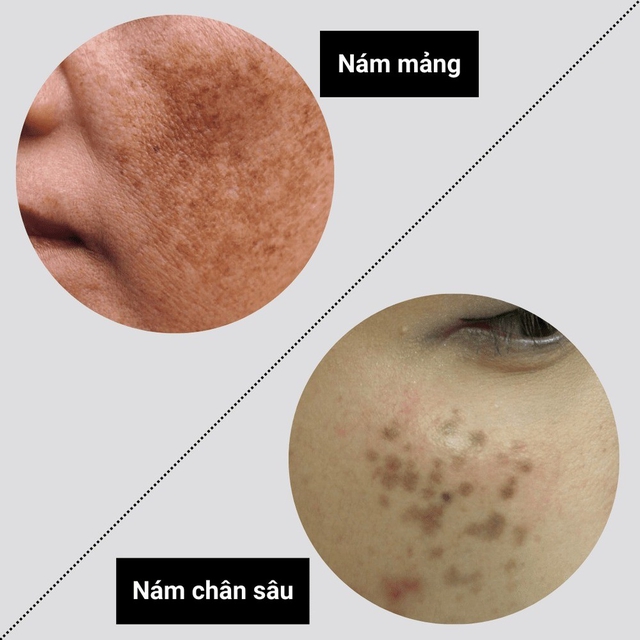 +3 kem mờ nám chân sâu sau khoảng 4 tuần khiến chị em không tin vào mắt- Ảnh 1.