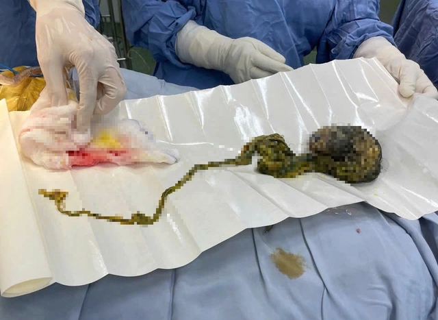 B&uacute;i t&oacute;c chiếm trọn dạ d&agrave;y b&eacute; trai 6 tuổi - Ảnh 1.