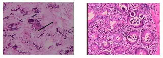 Đi ch&acirc;n đất, d&ugrave;ng corticoid t&ugrave;y tiện: Nguy cơ giun lươn g&acirc;y biến chứng tử vong - Ảnh 1.