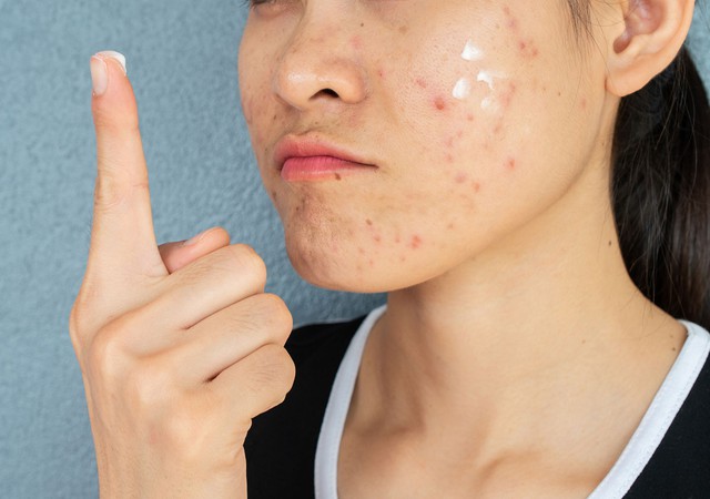 Da v&ugrave;ng m&aacute; dễ bị th&acirc;m mụn? C&aacute;ch chăm s&oacute;c da gi&uacute;p da đều m&agrave;u hơn- Ảnh 1.