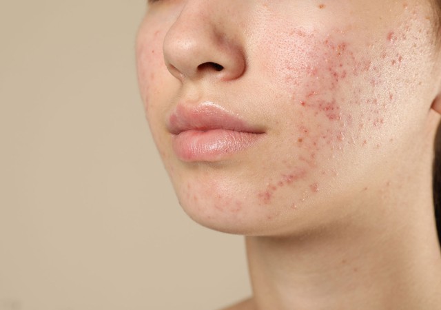 Da v&ugrave;ng m&aacute; dễ bị th&acirc;m mụn? C&aacute;ch chăm s&oacute;c da gi&uacute;p da đều m&agrave;u hơn- Ảnh 2.