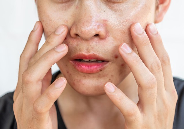 Da v&ugrave;ng m&aacute; dễ bị th&acirc;m mụn? C&aacute;ch chăm s&oacute;c da gi&uacute;p da đều m&agrave;u hơn- Ảnh 3.