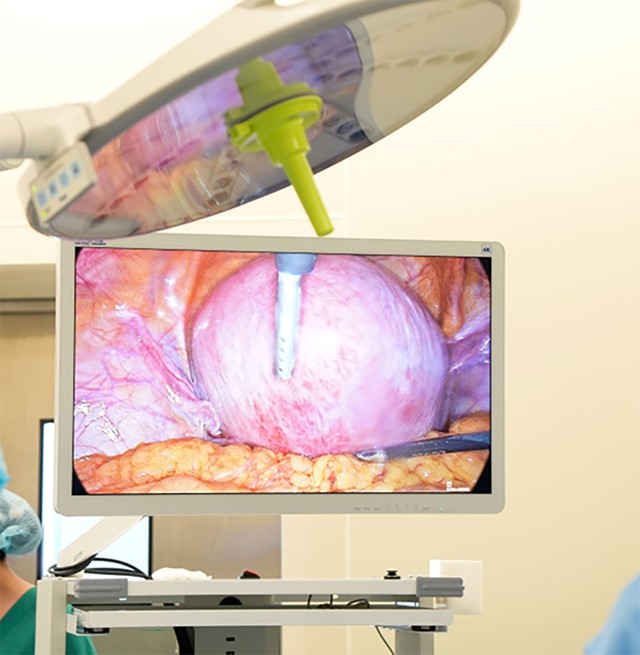 Giữ trọn tử cung bằng phẫu thuật nội soi tại Bệnh viện Phương Nam- Ảnh 2. Giữ trọn tử cung bằng phẫu thuật nội soi tại Bệnh viện Phương Nam- Ảnh 2.