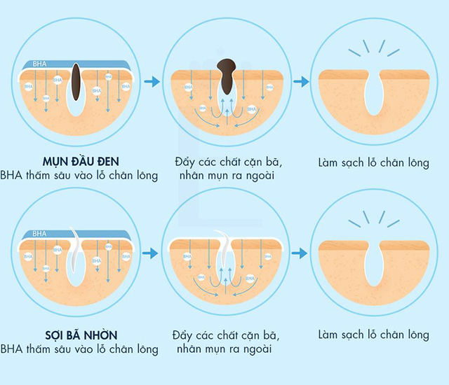 Da mụn nên dùng BHA hay AHA - phương pháp chăm da mụn chuẩn khoa học- Ảnh 1. Da mụn nên dùng BHA hay AHA - phương pháp chăm da mụn chuẩn khoa học- Ảnh 1.