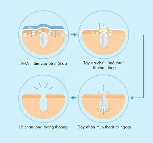 Da mụn nên dùng BHA hay AHA - phương pháp chăm da mụn chuẩn khoa học- Ảnh 2. Da mụn nên dùng BHA hay AHA - phương pháp chăm da mụn chuẩn khoa học- Ảnh 2.