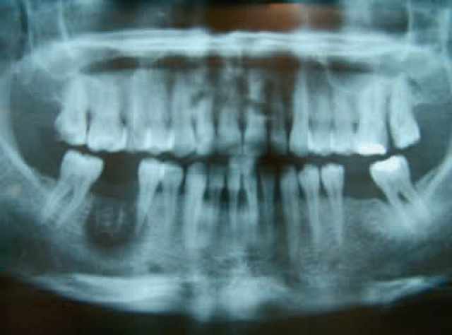 Sử dụng thạch tín trong điều trị nội nha gây nguy cơ gì ? - Ảnh 1.