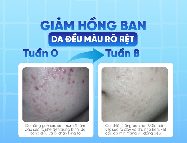 V&igrave; sao da sau mụn dễ th&acirc;m v&agrave; để lại sẹo? - Ảnh 6.