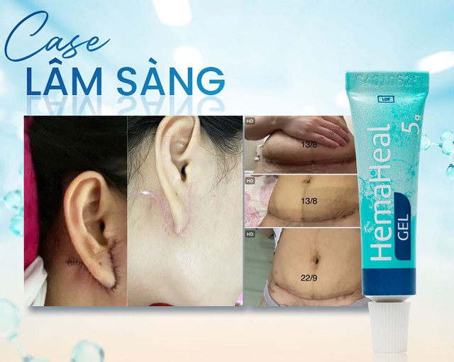 Gel b&ocirc;i vết thương hở HemaHeal c&oacute; hỗ trợ mau l&agrave;nh như quảng c&aacute;o kh&ocirc;ng? - Ảnh 1.