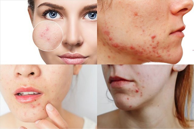 Vì sao da dễ nổi mụn sau Tết dù skincare rất kỹ? - Ảnh 3.