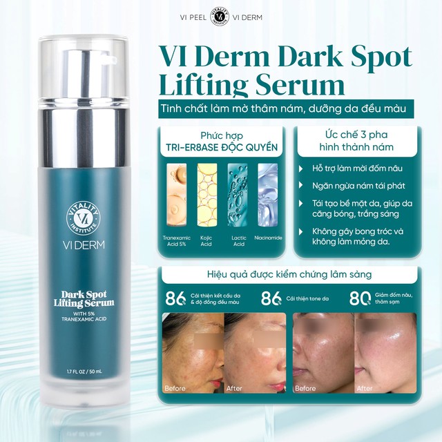 4 serum mờ n&aacute;m, t&agrave;n nhang ai cũng bất ngờ v&igrave; hiệu quả với cả ch&acirc;n s&acirc;u - Ảnh 2.