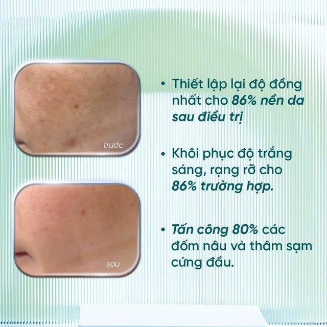 4 serum mờ n&aacute;m, t&agrave;n nhang ai cũng bất ngờ v&igrave; hiệu quả với cả ch&acirc;n s&acirc;u - Ảnh 3.