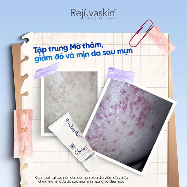 Th&acirc;m mụn n&ecirc;n b&ocirc;i g&igrave;, ăn g&igrave; để da nhanh đều m&agrave;u? Hướng dẫn chi tiết 2026 - Ảnh 3.