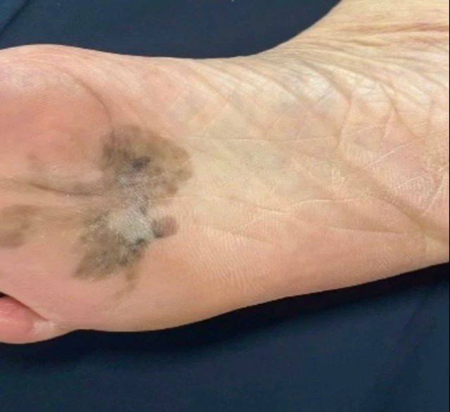 Nhận biết sớm ung thư từ v&ugrave;ng da đổi m&agrave;u ở b&agrave;n tay, ch&acirc;n  - Ảnh 1.