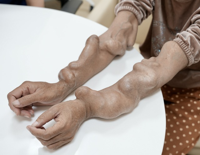 Điều trị ca bệnh thận nh&acirc;n tạo biến dạng tay do gi&atilde;n tĩnh mạch - Ảnh 1.