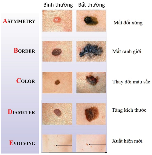 Nhận biết sớm ung thư từ v&ugrave;ng da đổi m&agrave;u ở b&agrave;n tay, ch&acirc;n  - Ảnh 2.