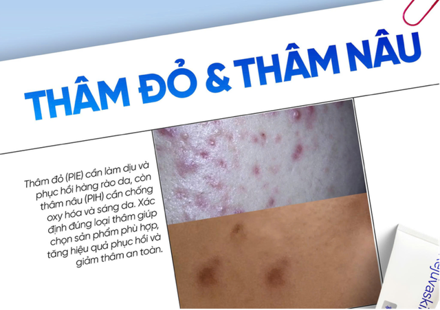 Top c&aacute;ch chăm s&oacute;c da th&acirc;m đỏ sau mụn bạn n&ecirc;n thử ngay trong routine hằng ng&agrave;y- Ảnh 1.