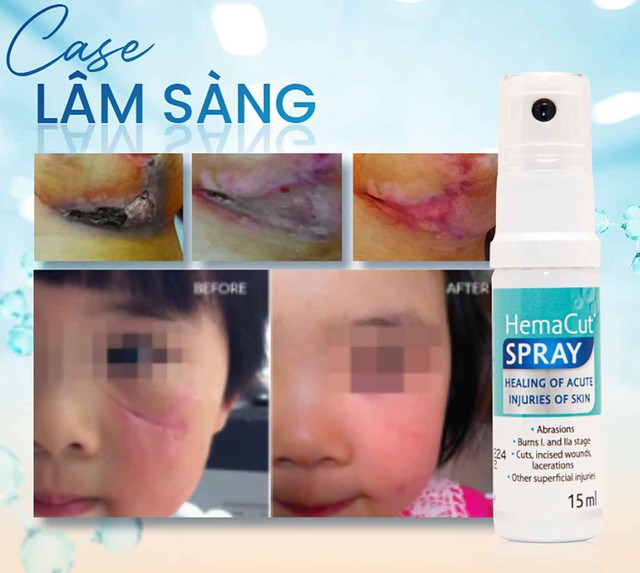 Sử dụng chai xịt vết thương khi nào để hạn chế nhiễm trùng, sẹo xấu?- Ảnh 6. Sử dụng chai xịt vết thương khi nào để hạn chế nhiễm trùng, sẹo xấu?- Ảnh 6.