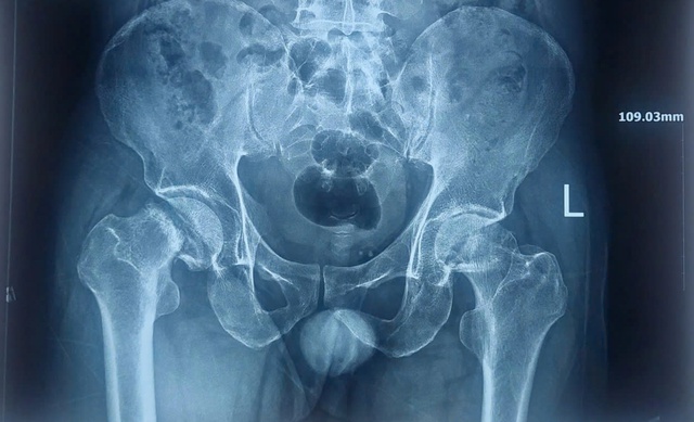 Đau khớp h&aacute;ng nhiều năm, đi kh&aacute;m ph&aacute;t hiện bị hoại tử xương cả hai b&ecirc;n đ&ugrave;i - Ảnh 1.