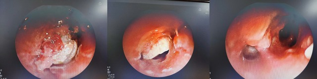 Nằm võng ăn bánh hạnh nhân, thiếu niên suýt mất mạng vì hóc dị vật - Ảnh 1.