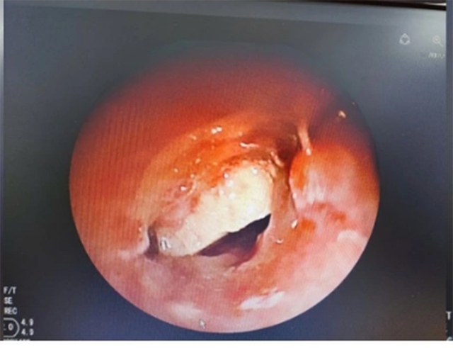 Nằm v&otilde;ng ăn b&aacute;nh hạnh nh&acirc;n, thiếu ni&ecirc;n su&yacute;t mất mạng v&igrave; h&oacute;c dị vật - Ảnh 1.