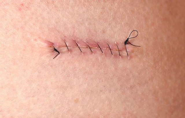 Kiểm so&aacute;t vi&ecirc;m sau phẫu thuật - Yếu tố quyết định h&igrave;nh th&aacute;i sẹo - Ảnh 1.