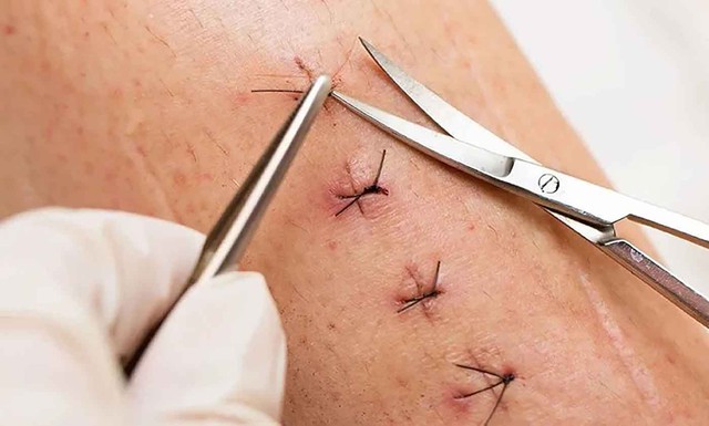 Vết thương sau bao l&acirc;u th&igrave; b&ocirc;i kem mờ sẹo để đạt hiệu quả sau 4-8 tuần?- Ảnh 2.