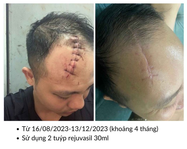 Vết thương sau bao l&acirc;u th&igrave; b&ocirc;i kem mờ sẹo để đạt hiệu quả sau 4-8 tuần?- Ảnh 3.