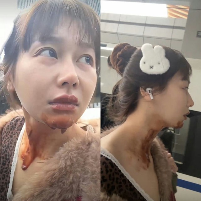 Nữ diễn vi&ecirc;n Wang Tianyu gặp tai nạn bỏng nghi&ecirc;m trọng khi đu trend b&aacute;nh kem bốc lửa - Ảnh 3.