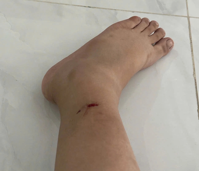 Nỗi ám ảnh chó dữ thả rông tấn liên tục cắn người tại TP.HCM - Ảnh 2.