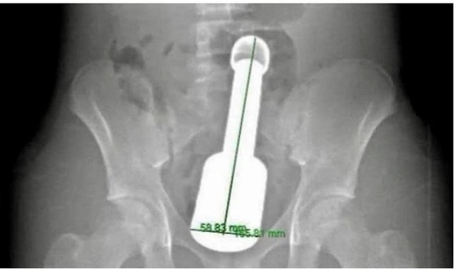 Ch&agrave;y kim loại kẹt trong trực tr&agrave;ng: Tuổi dậy th&igrave; v&agrave; t&acirc;m l&yacute; 'một m&igrave;nh, thử xem sao' - Ảnh 1.