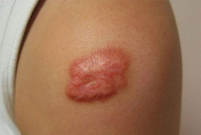 Quản trị rủi ro biến chứng hậu phẫu: Góc nhìn từ công nghệ Plasma lạnh - Ảnh 2.