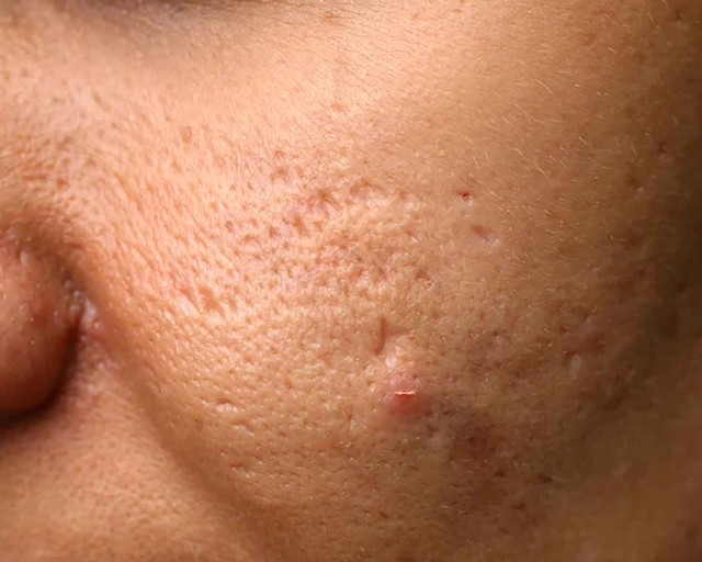 V&igrave; sao laser, b&oacute;c t&aacute;ch xong sẹo vẫn l&otilde;m lại? Chuy&ecirc;n gia giải th&iacute;ch cơ chế- Ảnh 2.