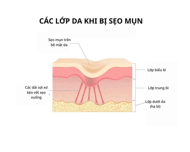 V&igrave; sao laser, b&oacute;c t&aacute;ch xong sẹo vẫn l&otilde;m lại? Chuy&ecirc;n gia giải th&iacute;ch cơ chế- Ảnh 3.